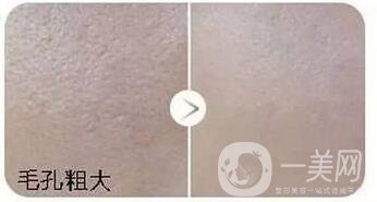 彩光嫩膚手術(shù)價(jià)格