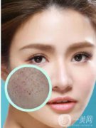 長(zhǎng)了黃褐斑怎么辦 光子嫩膚調(diào)節(jié)黃褐斑價(jià)格是多少？