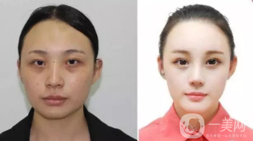 光子嫩膚價格多少錢,什么是光子嫩膚