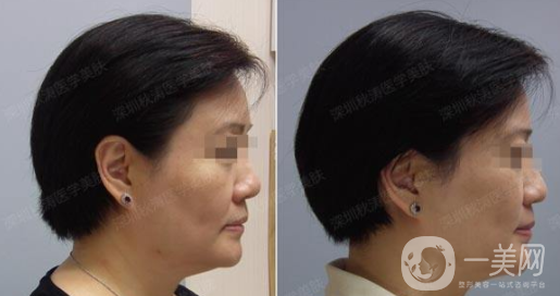 美容手術(shù)拉皮價(jià)格多少 美容拉皮好不好