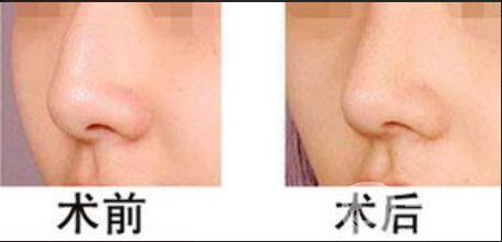 駝峰鼻矯正多少錢,駝峰鼻矯正貴不貴