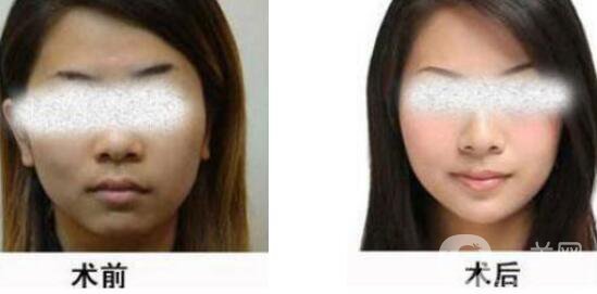 黑臉娃娃縮小毛孔多少錢？