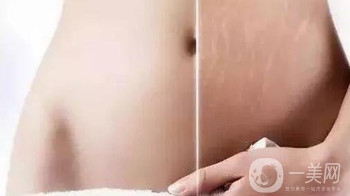 去妊娠紋價(jià)格是多少？