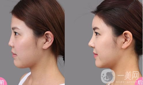 自體隆鼻價(jià)格是多少 *果好不好？
