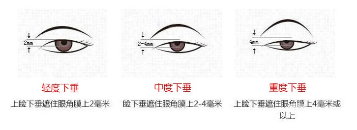 上瞼下垂矯治術(shù)*果怎么做 保持多久？