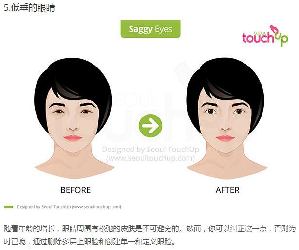 韓國做雙眼皮手術(shù)常見的5個問題解答