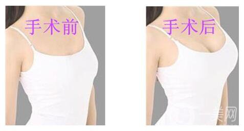 假體隆胸的恢復(fù)時間是多久？