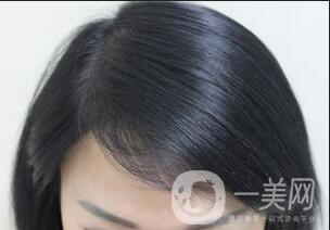 發(fā)際線(xiàn)種植恢復(fù)期