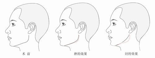 下頜角磨骨多久能喝酒 下頜角磨骨恢復時間