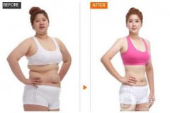 抽脂手術(shù)后需要多久恢復(fù) 果能維持多久