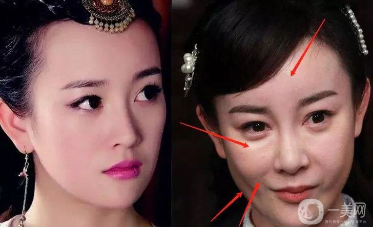 明星整容就是不承認(rèn)？ 然后突然臉“爛”了！