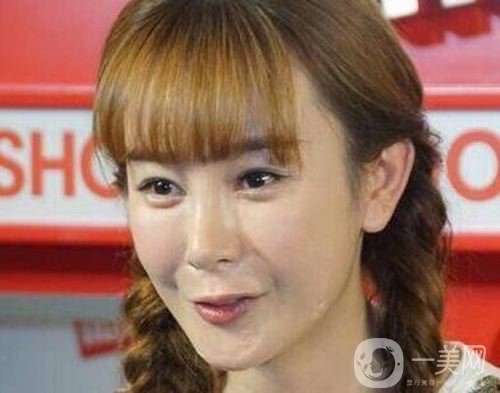 明星整容就是不承認(rèn)？ 然后突然臉“爛”了！