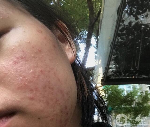 果酸換膚*果