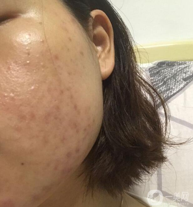 果酸換膚*果