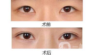 高分子割雙眼皮維持多長時間,高分子割雙眼皮注意事項