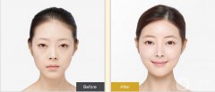開內(nèi)外眼角果如何？開眼角前后照片