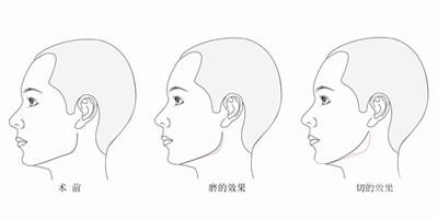 削骨手術危險嗎 削骨手術*果怎么樣
