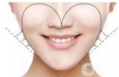面部吸脂修復手術多少錢 面部吸脂恢復時間