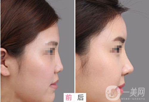 玻尿酸隆鼻多少錢(qián) 隆鼻的方式