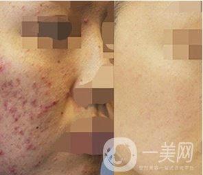 磨皮祛痘坑*果好嗎？去痘坑前后