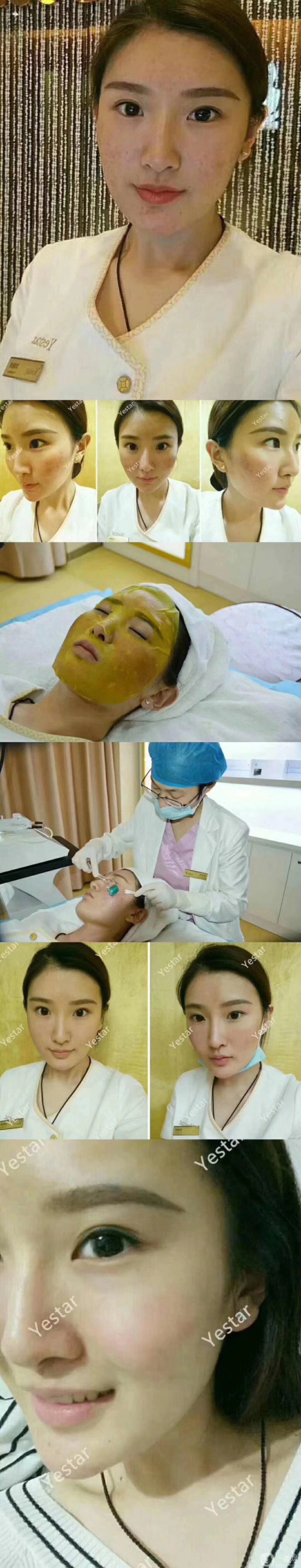 磨皮祛痘坑*果好嗎？去痘坑前后