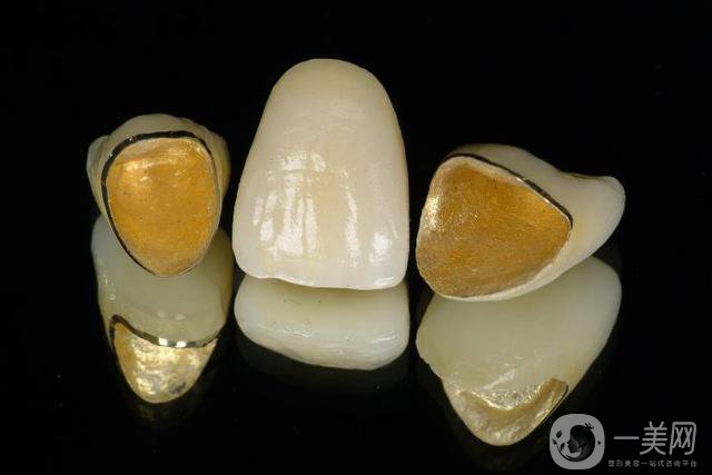 黃金烤瓷牙價格一般是多少？