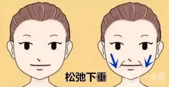 法令紋怎么祛除*果比較好？