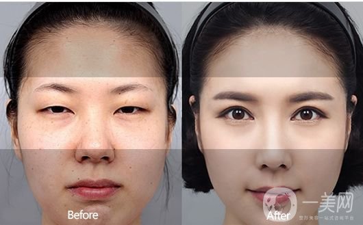 埋線雙眼皮好不好？埋線雙眼皮*果圖