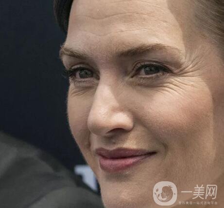 祛除眼角魚尾紋方法有哪些？價格一般是多少呢？