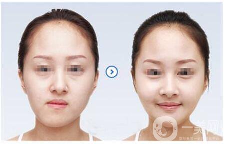 正頜手術(shù)的方法有哪些？