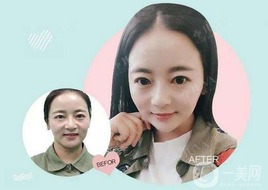 關(guān)于注射美容，你得了解這幾點干貨！