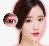 亞韓割雙眼皮多少錢？什么人不適合做這項(xiàng)手術(shù)呢？