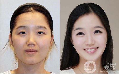 班加羅爾面部頸部抽脂術怎么樣 價格是多少？