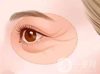 班加羅爾眼瞼手術(shù)*果怎么樣 多少錢？