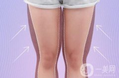 女性大腿吸脂一般多久恢復(fù)?*嗎?