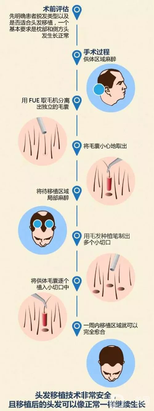 毛發(fā)移植*果怎么樣？毛發(fā)移植原理是什么？