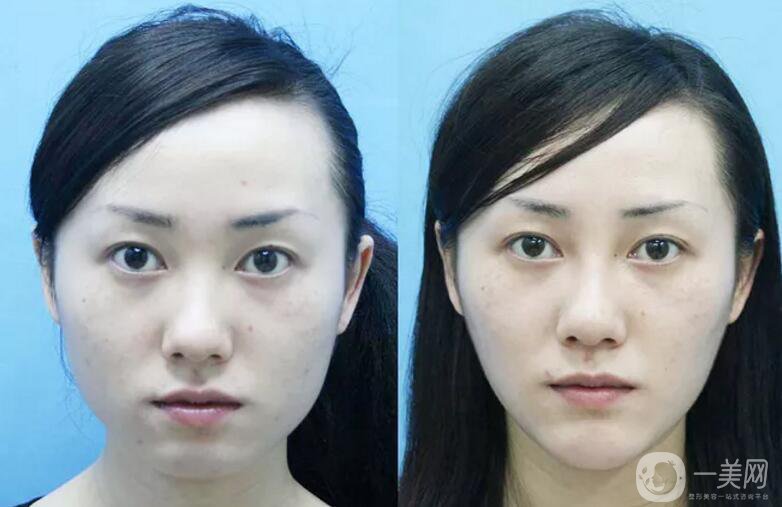 下頜角磨骨整形價(jià)格貴嗎？需要多少錢(qián)？