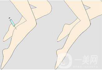 射頻瘦小腿優(yōu)缺點有哪些 射頻瘦小腿方法