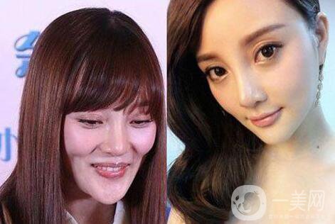 又一個整容失敗的女明星，鼻子都整歪了，不甘心揚言還要植發(fā)！