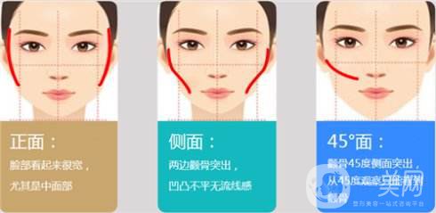 面部磨顴骨術后恢復要多久 磨顴骨*嗎