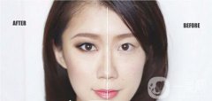 重慶做雙眼皮要多少錢 割雙眼皮有風(fēng)險(xiǎn)嗎