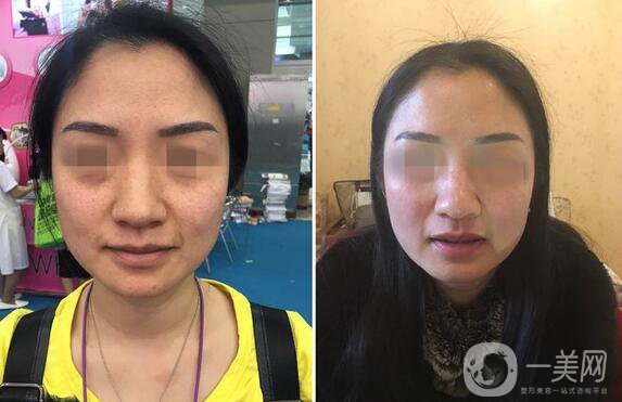 到底哪種面部提升手術(shù)適合你？