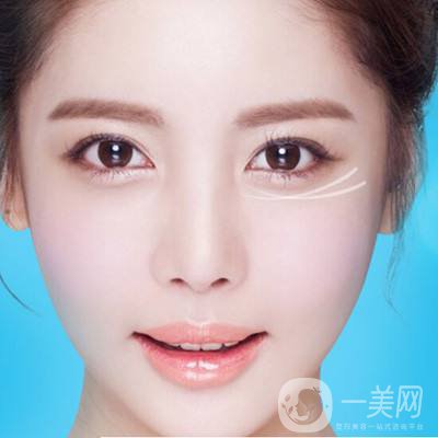 深圳去眼袋手術(shù)多少錢 去眼袋有什么風(fēng)險(xiǎn)嗎？
