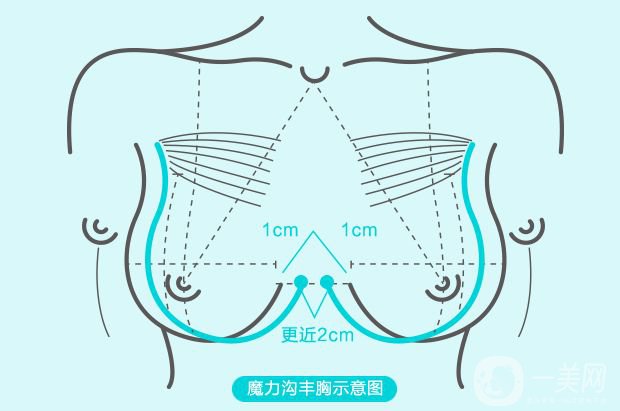 沃斯堡豐胸術(shù)怎么樣 隆胸的風(fēng)險(xiǎn)有多大？