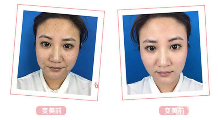 光子嫩膚*果介紹？對皮膚會有傷害嗎？