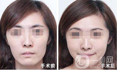 臉頰隆起的原因是什么 手術(shù)怎么做？