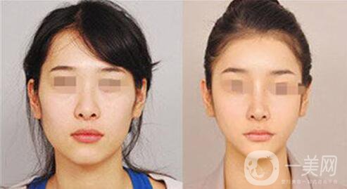 下頜整形手術的方法有哪些？