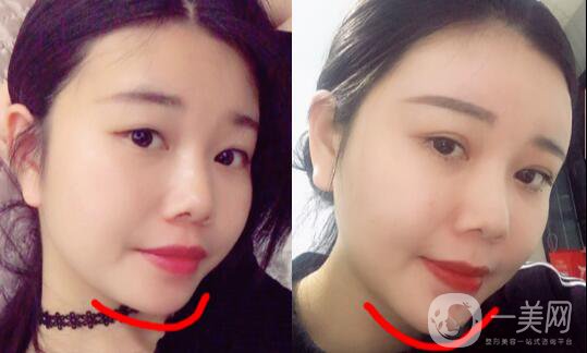 自體脂肪墊下巴恢復期是怎樣的？如何做好術后護理？