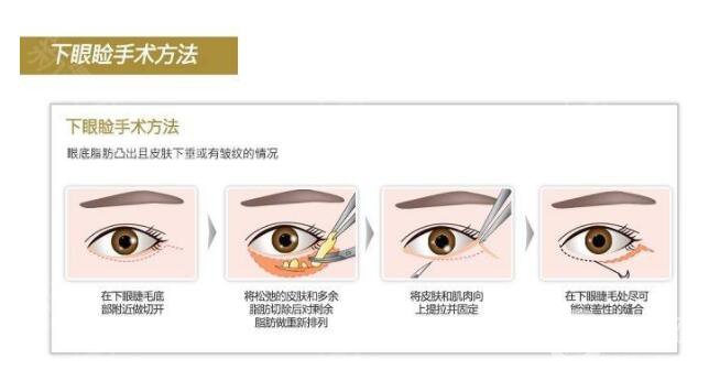 沃斯堡眼瞼手術(shù)怎么樣 有風(fēng)險嗎？