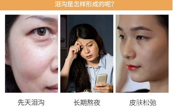 膠原蛋白填淚溝恢復(fù)期是多久呢 術(shù)后護(hù)理要注意什么？